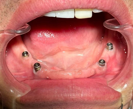 Slider image (8) Smiletec® - Leading Mexicali Dental Clinic